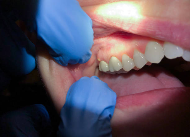 Best Emergency Tooth Extraction in South Woodstock, CT